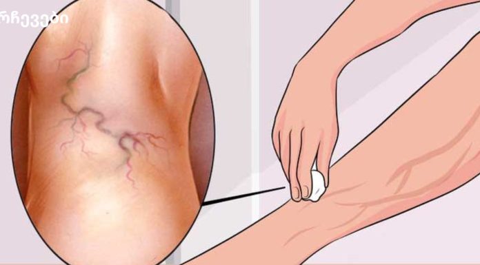 სამუდამოდ მოიშორეთ ვარიკოზული ვენები ერთი მარტივი ინგრედიენტით!