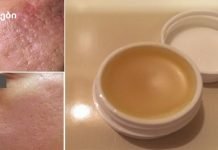 უნიკალური სახლის კრემი, რომელიც დაგეხმარებათ ნაწიბურების სრულად მოცილებაში 2 კვირის განმავლობაში!