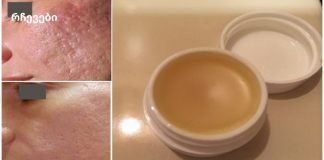 უნიკალური სახლის კრემი, რომელიც დაგეხმარებათ ნაწიბურების სრულად მოცილებაში 2 კვირის განმავლობაში!