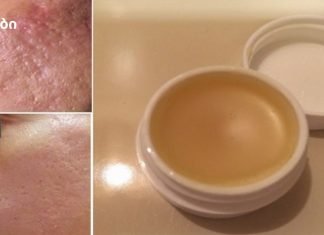 უნიკალური სახლის კრემი, რომელიც დაგეხმარებათ ნაწიბურების სრულად მოცილებაში 2 კვირის განმავლობაში!