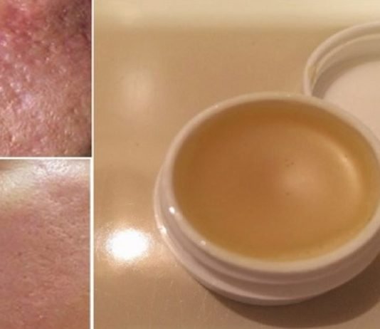 უნიკალური სახლის კრემი, რომელიც დაგეხმარებათ ნაწიბურების სრულად მოცილებაში 2 კვირის განმავლობაში!