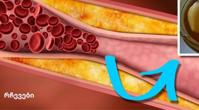 ეს სასმელი გაწმენდს თქვენს არტერიებს და დაიცავს თქვენს გულს!
