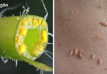 მეჭეჭები გაქვთ? აი, როგორ უნდა ამოიღოთ ისინი სამუდამოდ!