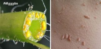 მეჭეჭები გაქვთ? აი, როგორ უნდა ამოიღოთ ისინი სამუდამოდ!