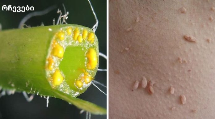 მეჭეჭები გაქვთ? აი, როგორ უნდა ამოიღოთ ისინი სამუდამოდ!