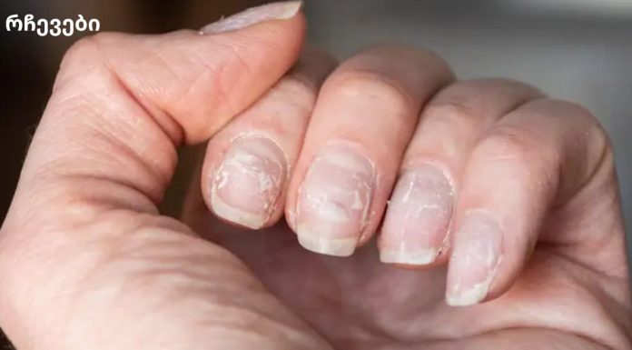 რა შეიძლება იყოს ფრჩხილის ზედაპირის დარღვევის მიზეზი ჯანმრთელობასთან მიმართებაში?