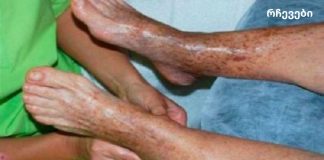 ეფექტური რჩევები ცუდი მიმოქცევის პრობლემის გადასაჭრელად