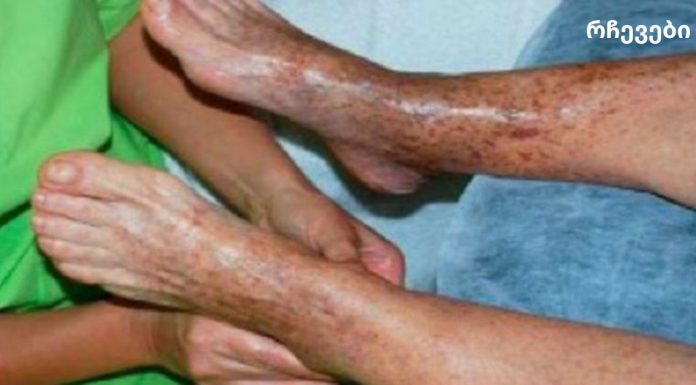 ეფექტური რჩევები ცუდი მიმოქცევის პრობლემის გადასაჭრელად