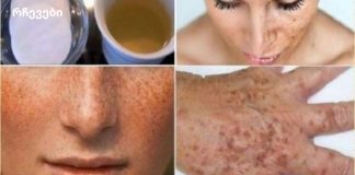 გაათეთრეთ კანი და გაასუფთავეთ სიხშირე და მუქი ლაქები ამ ხელნაკეთი ლოსიონით