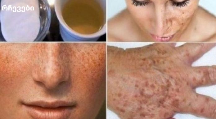 გაათეთრეთ კანი და გაასუფთავეთ სიხშირე და მუქი ლაქები ამ ხელნაკეთი ლოსიონით