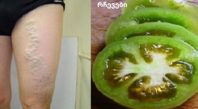 როგორ განვკურნოთ ვარიკოზული ვენები პომიდვრით