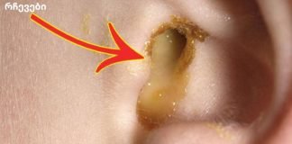 ყურადღება მიაქციეთ ყურის ინფექციას! აი, როგორ შეგიძლიათ განკურნოთ ინფექციები მხოლოდ 1 დღეში!