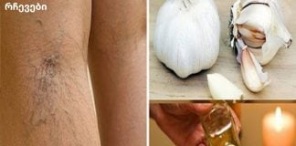 დაემშვიდობეთ ვარიკოზულ ვენებს ბუნებრივად!