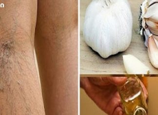 დაემშვიდობეთ ვარიკოზულ ვენებს ბუნებრივად!