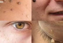 მოიშორეთ ფიბრომები და მეჭეჭები ახლავე მარტივად!