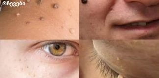 მოიშორეთ ფიბრომები და მეჭეჭები ახლავე მარტივად!