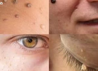 მოიშორეთ ფიბრომები და მეჭეჭები ახლავე მარტივად!