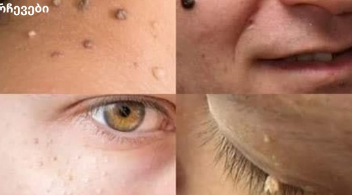 მოიშორეთ ფიბრომები და მეჭეჭები ახლავე მარტივად!