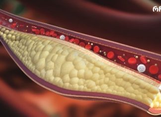 ამ წვენის მხოლოდ 1 ჭიქა დაგეხმარებათ არტერიების გაწმენდაში!