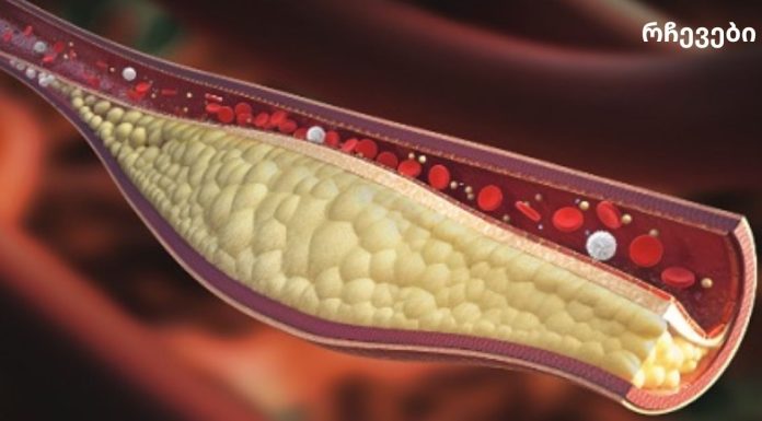 ამ წვენის მხოლოდ 1 ჭიქა დაგეხმარებათ არტერიების გაწმენდაში!