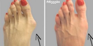 რატომ ინახავენ ექიმები ამ მარტივ რეცეპტს საზოგადოებისგან საიდუმლოდ? ჩვენ გეტყვით, თუ როგორ მოიშოროთ ძვლის წანაზარდები ხალხური მეთოდით!