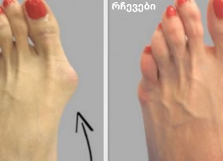 რატომ ინახავენ ექიმები ამ მარტივ რეცეპტს საზოგადოებისგან საიდუმლოდ? ჩვენ გეტყვით, თუ როგორ მოიშოროთ ძვლის წანაზარდები ხალხური მეთოდით!