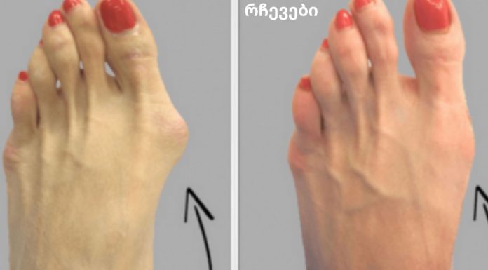 რატომ ინახავენ ექიმები ამ მარტივ რეცეპტს საზოგადოებისგან საიდუმლოდ? ჩვენ გეტყვით, თუ როგორ მოიშოროთ ძვლის წანაზარდები ხალხური მეთოდით!