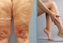 როგორ მოვიშოროთ ცელულიტი სახლის პირობებში?