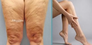 როგორ მოვიშოროთ ცელულიტი სახლის პირობებში?