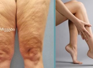 როგორ მოვიშოროთ ცელულიტი სახლის პირობებში?