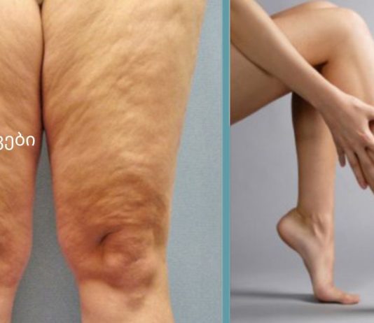 როგორ მოვიშოროთ ცელულიტი სახლის პირობებში?