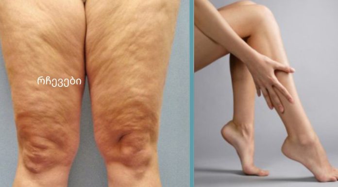 როგორ მოვიშოროთ ცელულიტი სახლის პირობებში?