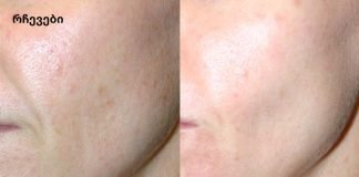 აღარ იქნება ნაოჭები და სახის კანი – და მხოლოდ 2 ინგრედიენტი!