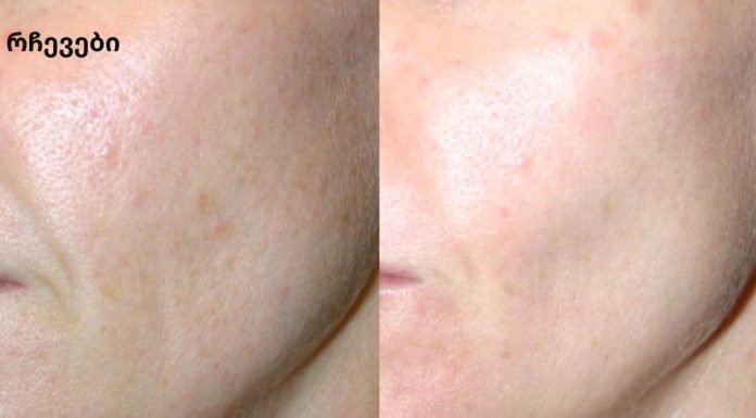 აღარ იქნება ნაოჭები და სახის კანი – და მხოლოდ 2 ინგრედიენტი!