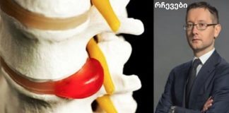 მალათაშუა თიაქრის მკურნალობა წამლებისა და ოპერაციის გარეშე: ზურგის ვარჯიშები პრაქტიკოსისგან