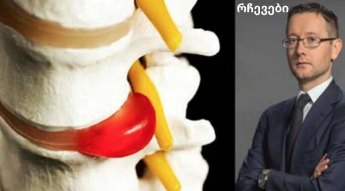 მალათაშუა თიაქრის მკურნალობა წამლებისა და ოპერაციის გარეშე: ზურგის ვარჯიშები პრაქტიკოსისგან