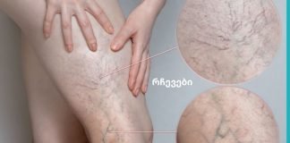 ვარიკოზული ვენები ზაფხულში.წესები, რომელიც უნდა დაიცვათ, თუ გსურთ განკურნოთ ვარიკოზული ვენები იხილეთ “წესები”