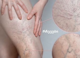 ვარიკოზული ვენები ზაფხულში.წესები, რომელიც უნდა დაიცვათ, თუ გსურთ განკურნოთ ვარიკოზული ვენები იხილეთ “წესები”