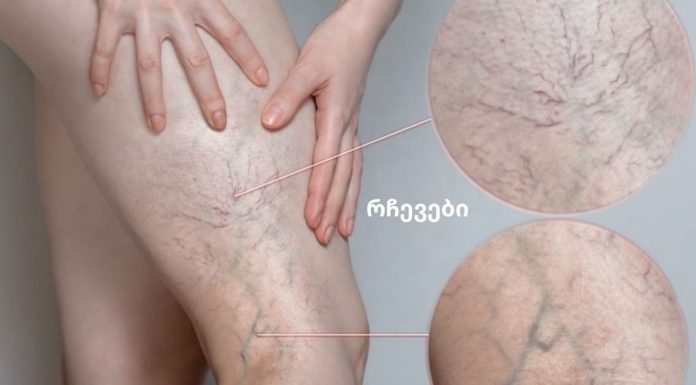 ვარიკოზული ვენები ზაფხულში.წესები, რომელიც უნდა დაიცვათ, თუ გსურთ განკურნოთ ვარიკოზული ვენები იხილეთ “წესები”