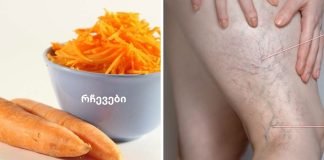 როგორ კურნავდა ჩემი მეზობელი ბებია ვენების ვარიკოზს სტაფილოთი