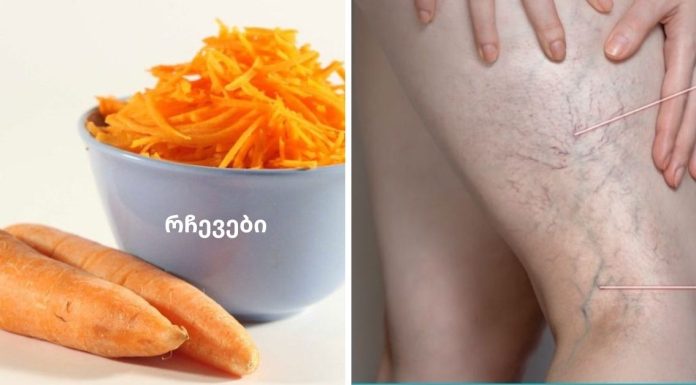 როგორ კურნავდა ჩემი მეზობელი ბებია ვენების ვარიკოზს სტაფილოთი