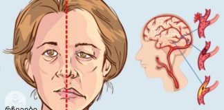 ინსულტის 3 პირველი ნიშანი: დაიმახსოვრე ეს სიცოცხლის გადარჩენაში დაგეხმარებათ!