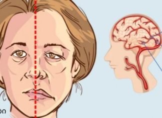 ინსულტის 3 პირველი ნიშანი: დაიმახსოვრე ეს სიცოცხლის გადარჩენაში დაგეხმარებათ!