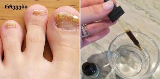 ყველაზე ეფექტური საშინაო ხალხური საშუალება ფეხის ფრჩხილის სოკოსგან გაგანთავისუფლებთ.