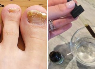 ყველაზე ეფექტური საშინაო ხალხური საშუალება ფეხის ფრჩხილის სოკოსგან გაგანთავისუფლებთ.