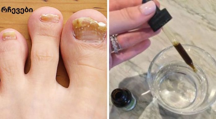 ყველაზე ეფექტური საშინაო ხალხური საშუალება ფეხის ფრჩხილის სოკოსგან გაგანთავისუფლებთ.