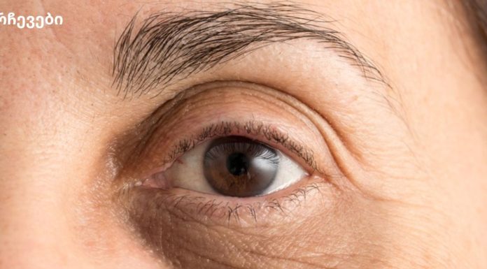 მოიშორეთ ჩაშავებული უპეები სისხლჩაქცევებისგან და შეშუპებისგან.