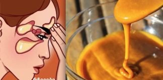 ლორწოს ძალიან ძლიერი საშუალება, ის მოგიხსნით ცხვირიდან გამონადენს, სინუსიტს და ხველას