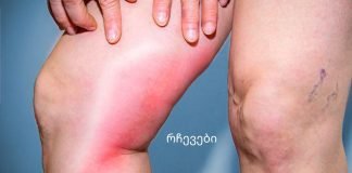 თრომბოზის საშიში ნიშნები, რომლებმაც შეიძლება მოგკლათ!