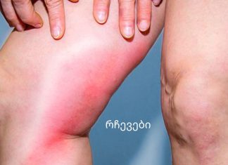 თრომბოზის საშიში ნიშნები, რომლებმაც შეიძლება მოგკლათ!